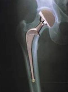 Is leg swelling a possible complication following hip replacement?